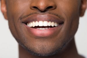 Tooth Bonding and Cosmetic Fixes - Dentists in Burlington, NC